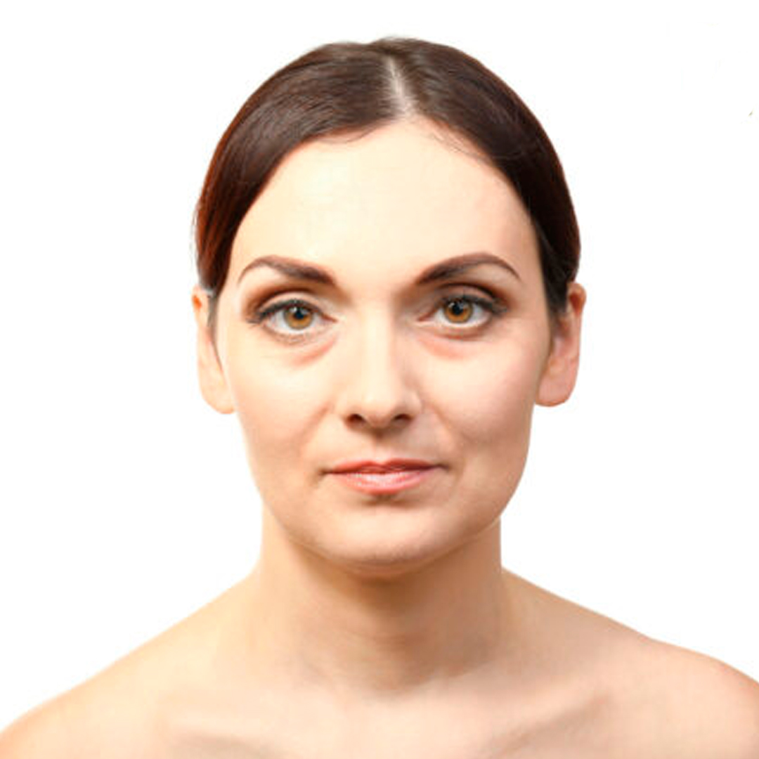 Antes del tratamiento: Blefaroplastia No Invasiva