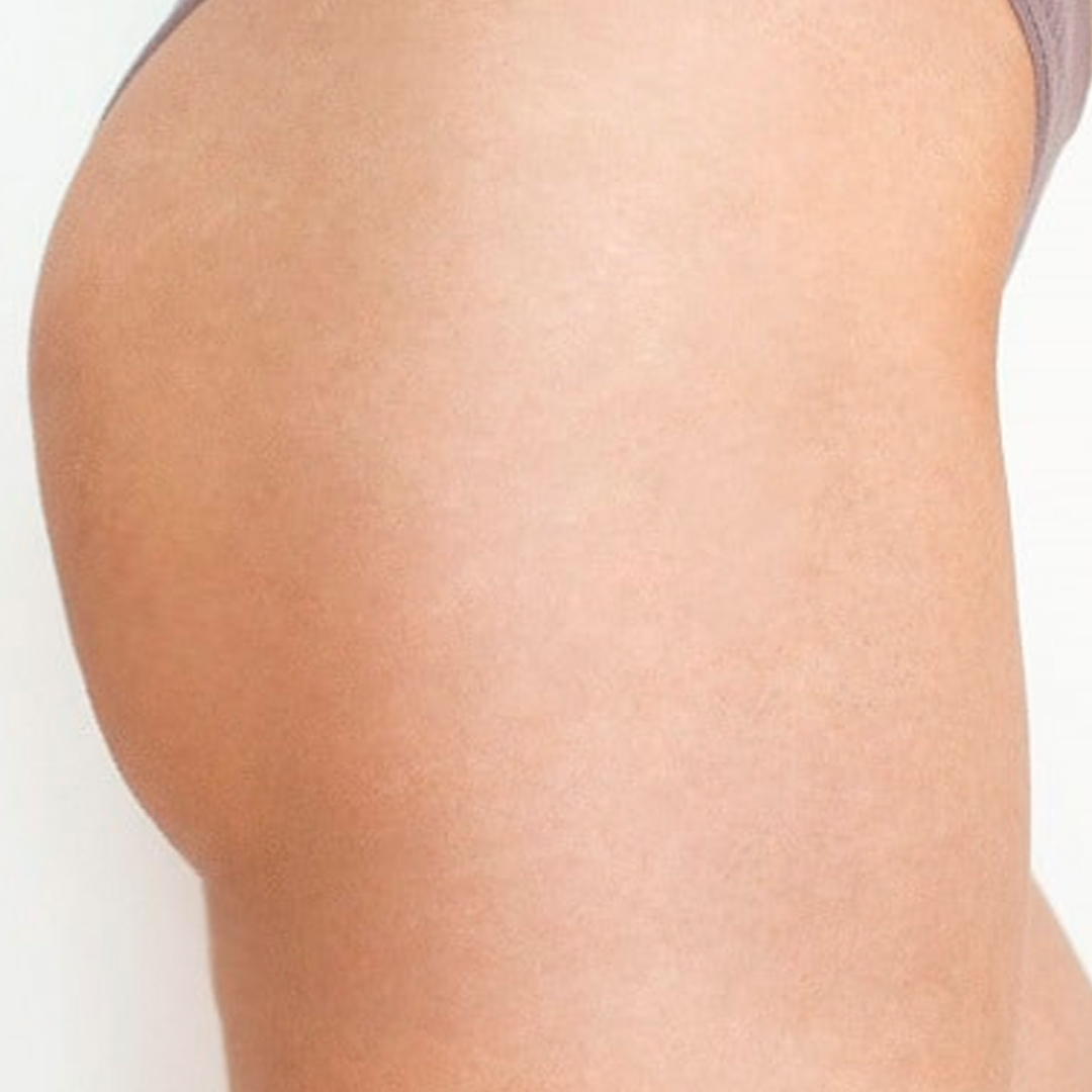 Después del tratamiento: Tratamiento de Estrías